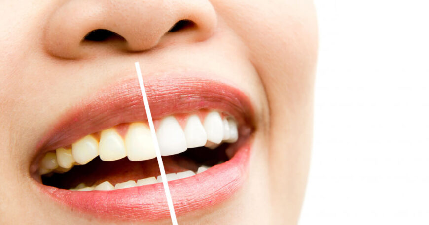 أفضل طريقة لتبييض الأسنان طبياً ليزر أم زوم؟ والتكلفة