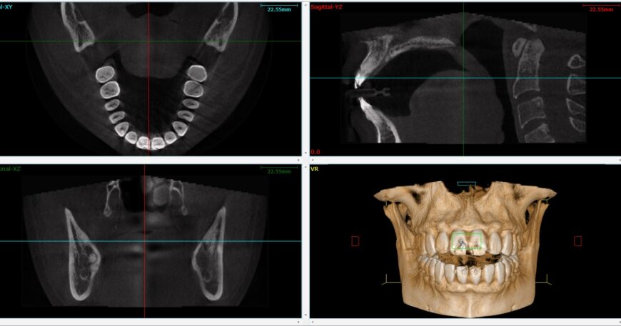 اشعة cbct للاسنان - دقة ثلاثية الأبعاد ووداعاً للتشخيص الخاطئ
