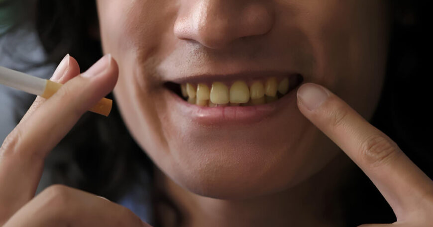 تبييض الأسنان بسرعة في البيت طبيب يوافق (آمن 100%)