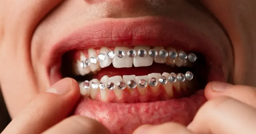 طريقة تعديل الاسنان في البيت - الإجابة الصادمة حول المطاطات