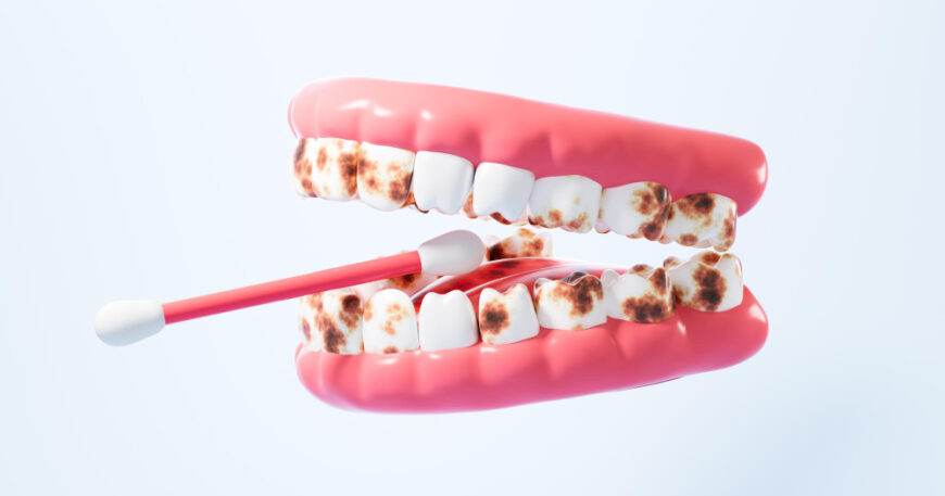 الفرق بين جير الأسنان والتسوس - الأعراض وطرق العلاج