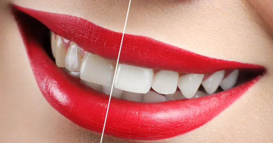 تبييض الاسنان بتقنية البلازما - السرعة والنتائج الفورية