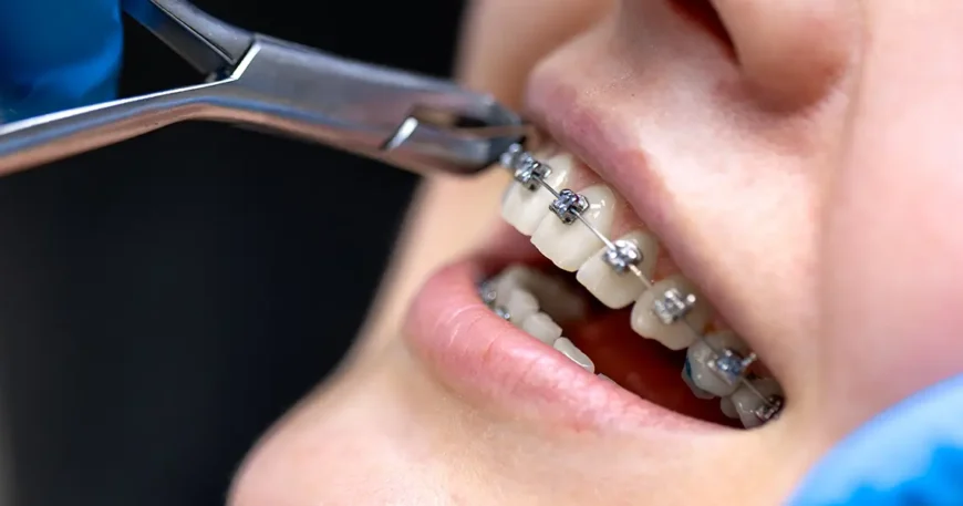 فوائد ونتائج تقويم الاسنان بعد سن العشرين للبالغين