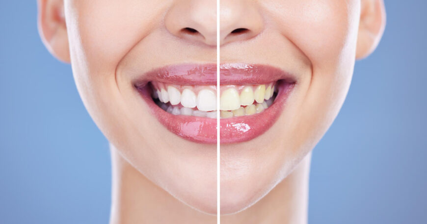 كم سعر تنظيف الأسنان من التسوس؟ دليلك للتوفير والراحة