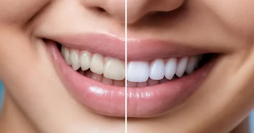 كيف تختار افضل جهاز تبييض الأسنان المنزلي؟ (مقارنة شاملة)