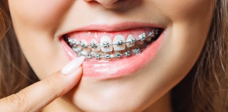 أفضل حل للاسنان غير التقويم لعام 2026