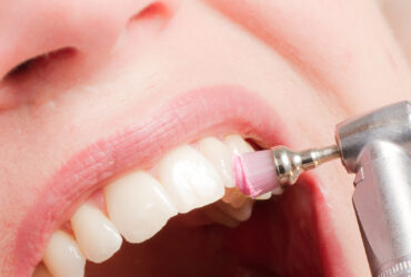 أهمية جلسات تنظيف الاسنان في إزالة الجير وتبييض الابتسامة