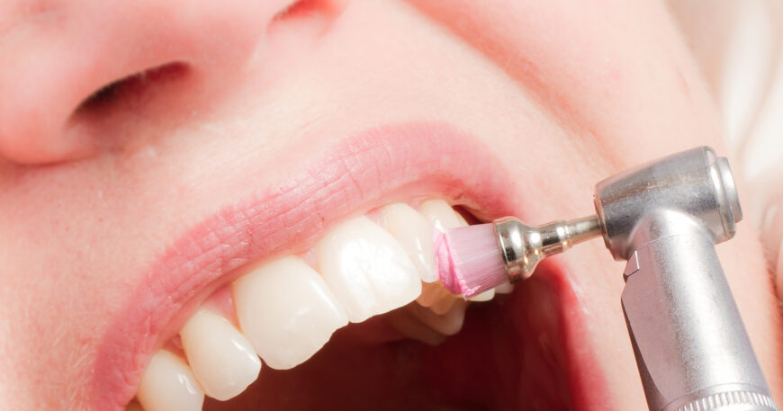 أهمية جلسات تنظيف الاسنان في إزالة الجير وتبييض الابتسامة