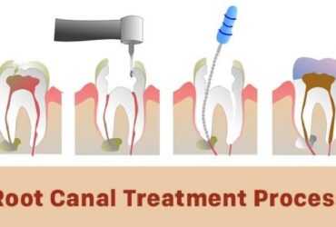 اسعار حشو العصب في مصر 2026 - دليل محدث
