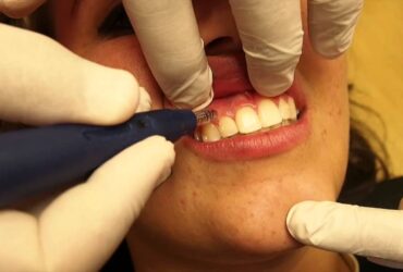 الحقيقة - هل يتغير شكل الوجه بعد تقويم الاسنان للأفضل؟