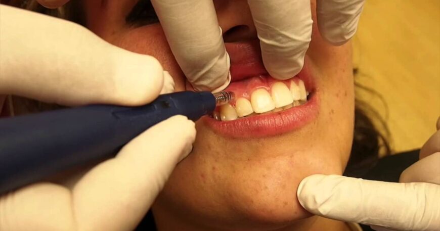 الحقيقة - هل يتغير شكل الوجه بعد تقويم الاسنان للأفضل؟