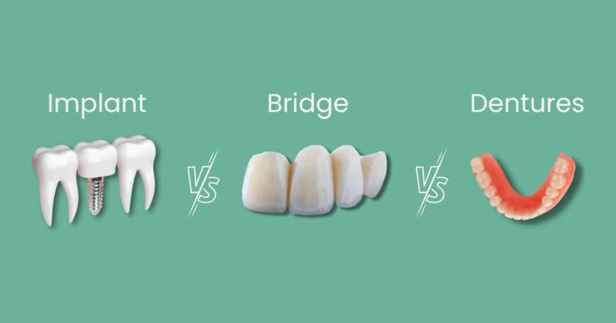 بدائل زراعة الاسنان - الجسور والأطقم ومميزات كل نوع