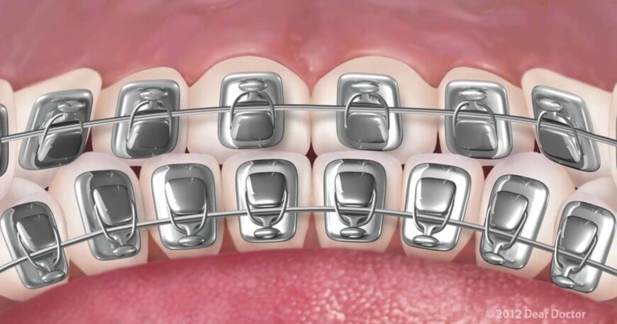 تقويم الاسنان بعد سن الاربعين - المميزات والأنواع الشفافة