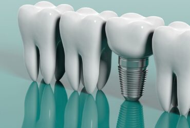 تكلفة زراعة الاسنان في مصر 2026 - دليل شامل