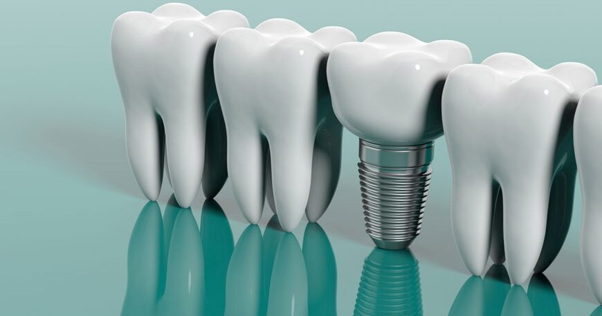 تكلفة زراعة الاسنان في مصر 2026 - دليل شامل