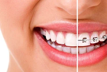 دليلك لـ تقويم الاسنان بعد سن الثلاثين والأنواع غير المرئية