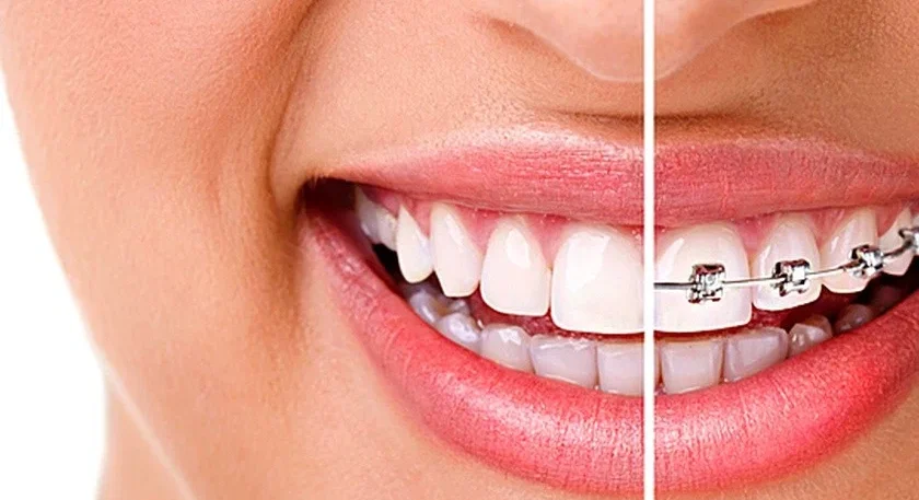 دليلك لـ تقويم الاسنان بعد سن الثلاثين والأنواع غير المرئية