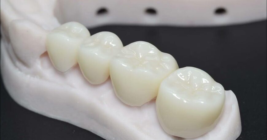 سعر الطربوش البورسلين للأسنان - هل هو الأنسب لك؟