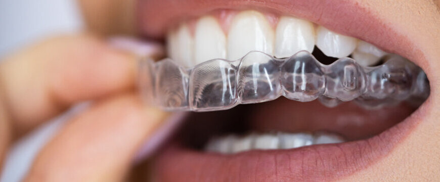سعر ومميزات تقويم الاسنان الانفزلاين في 2026