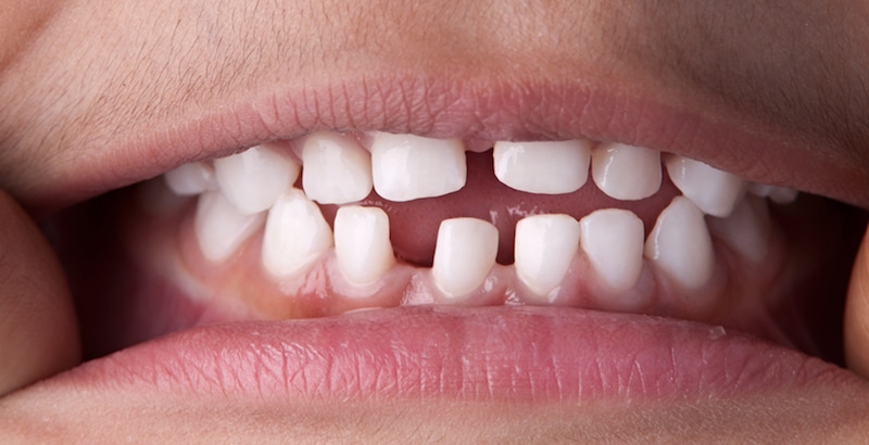 طرق إغلاق فراغات الاسنان بدون تقويم في جلسة واحدة فقط