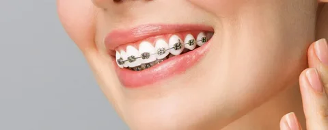 قبل خلع التقويم.. كيف اعرف ان تقويم الاسنان ناجح