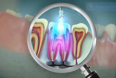 كم تبلغ اسعار حشو العصب بالليزر؟ دليل التكلفة والنتائج