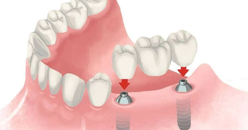كيف تختار افضل انواع الاسنان للزراعه - دليل شامل وكامل