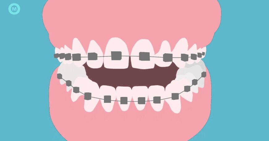 كيفية غسل الاسنان بالتقويم - خطوات بسيطة لأسنان بيضاء