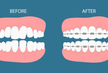 مراحل تقويم الاسنان بالتفصيل في 2026 لابتسامة مثالية وواثقة