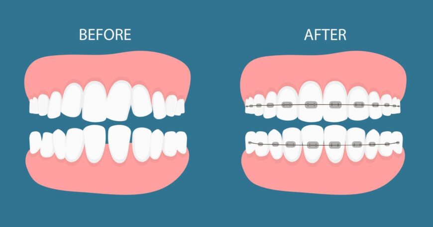 مراحل تقويم الاسنان بالتفصيل في 2026 لابتسامة مثالية وواثقة