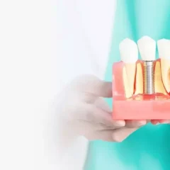 تجربتي مع زراعة الاسنان: القصة الكاملة من الألم إلى الابتسامة المثالية