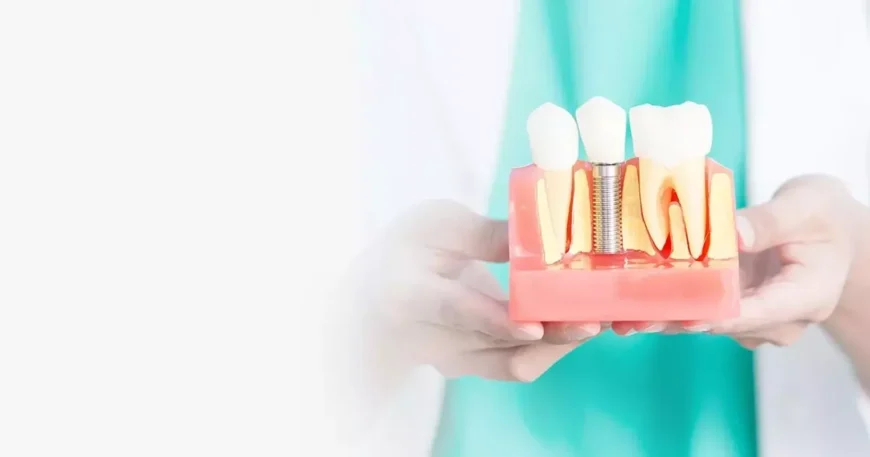 تجربتي مع زراعة الاسنان - القصة الكاملة من الألم للنجاح