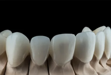 كم يبلغ سعر طربوش الاسنان الزيركون؟ دليل المزايا والنتائج كم يبلغ سعر طربوش الاسنان الزيركون؟ دليل المزايا والنتائج