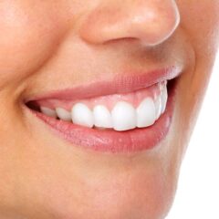 علاج الضحكة اللثوية: دليلك الشامل لأحدث الحلول التجميلية 2026